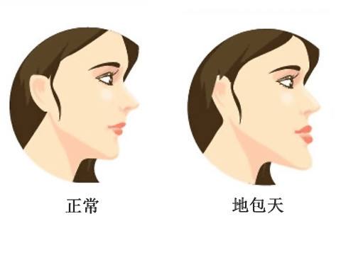 什么是地包天？地包天長什么樣子？地包天牙齒圖片