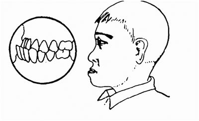 什么是地包天？地包天長什么樣子？地包天牙齒圖片