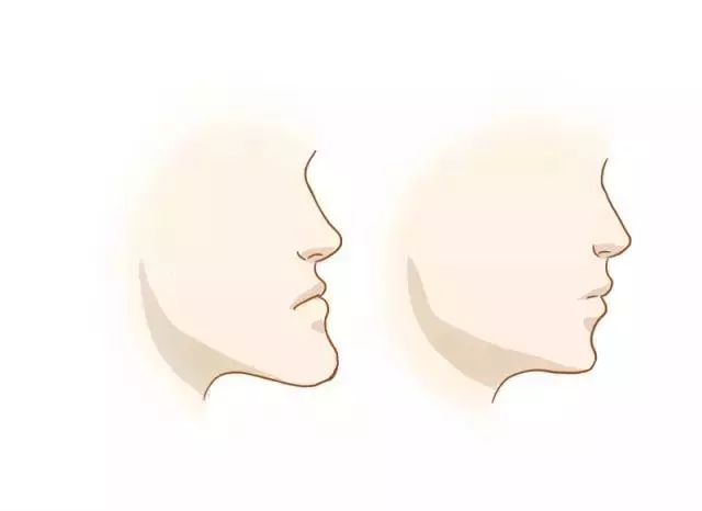 什么是地包天？地包天長什么樣子？地包天牙齒圖片